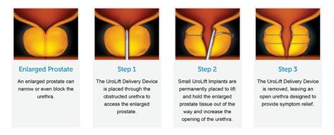 UroLift Specialist UroLift Treatment Desert Sky Urology Arizona
