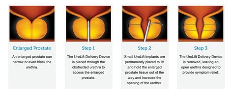 Urolift Specialist Urolift Treatment Desert Sky Urology Arizona