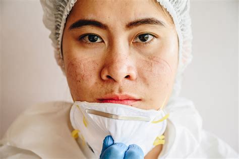 Masks And Acne Heres What You Can Do About Maskne Uchealth Today
