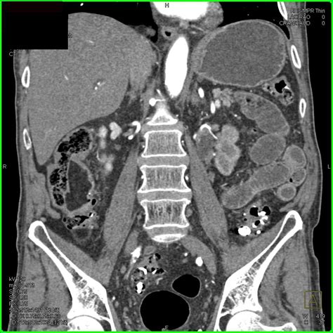 Bladder Cancer Obstructs The Left Ureter Genitourinary Case Studies