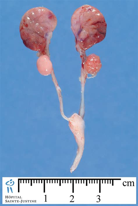 bilateral renal hypoplasia - Humpath.com - Human pathology