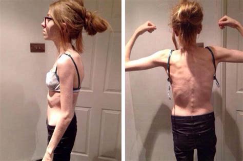 Girl Recovers From Life Threatening Eating Disorder After Weight