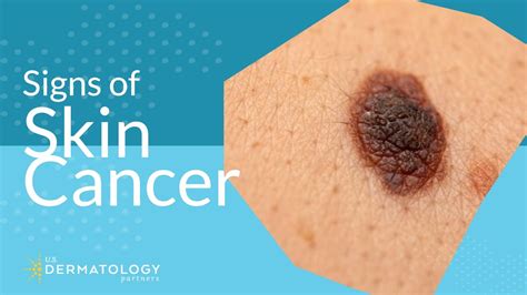 Skin Cancer Screening Symptoms Types And Warning Signs Youtube
