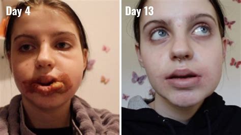 Double Jaw Surgery Days 4 13 Youtube