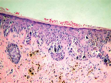 Intraepidermic Component Of Lentigo Maligna Melanoma Haematoxylin