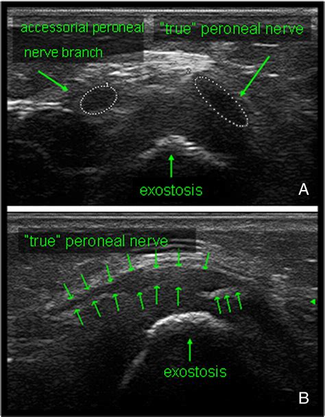 Ultrasound Diagnosis Of Peroneal Nerve Variant In A Child With