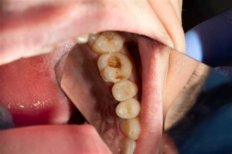 7 Early Signs Of A Cavity Forming In Your Teeth Cian Blog