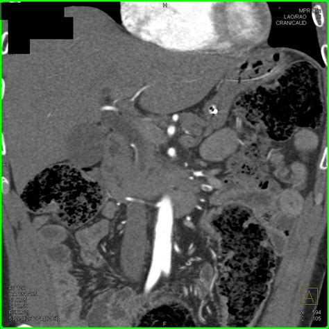 Een longembolie is een bloedprop (stolsel) die is vastgelopen in een of meer bloedvaten van de long. Superior Mesenteric Artery (SMA) Thrombi and Pulmonary ...