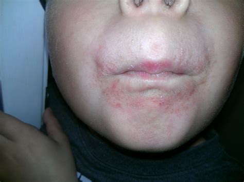 My Son Is 6 His Rash Started Around The Mouth Looking Like