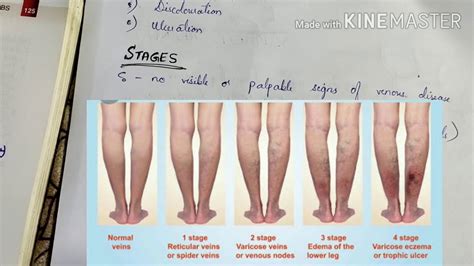 Varicose Veins Definition Cause Symptoms Stages Complications