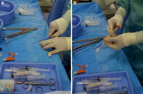 Replacement Of Mushroom Cage Gastrostomy Tube Using A Modified
