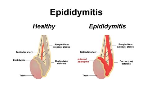 Epididymitis Is Inflammation Of The Epididymis Of The Testicle