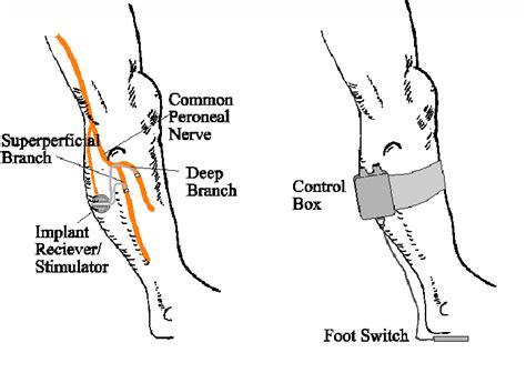 A Two Channel Implantable Peroneal Nerve Stimulator Stimustep Allows