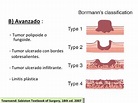 Clasificación de Bormann para tumores gástricos | Medicine, Study tips, Med