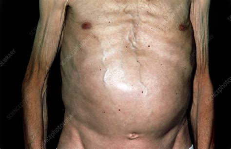 Swollen Abdomen Due To Spreading Skin Cancer Stock Image M1310293 Science Photo Library