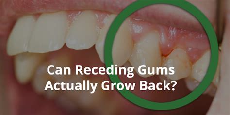 Wellness Lab Health Info Can Receding Gums Actually Grow Back