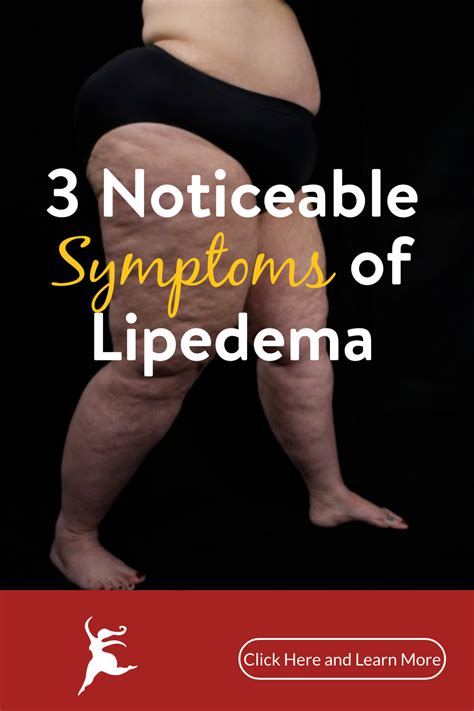 Lipedema Part 4 Possible Causes And Associated Conditions Artofit
