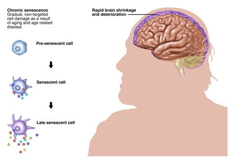 Chronic Senescence And Brain Shrinkage Poster Print By Gwen Shockey Science Source X