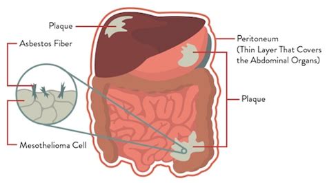 Peritoneal mesothelioma is a rare form of cancer and affects the lining of the abdomen when ingestion of microscopic asbestos fibers become embedded in the peritoneum. What is mesothelioma? | Guest Blog | Independent Living