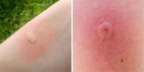 Here Are 12 Common Insect Bites And How To Recognize Them Tips And