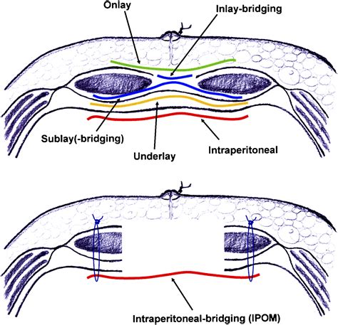 An Alternative Classification Of Incisional Hernias Enlisting