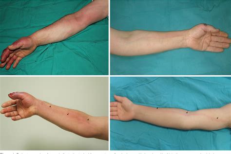 Figure 1 From Traumatic Acute Lymphangitis In The Upper Extremity
