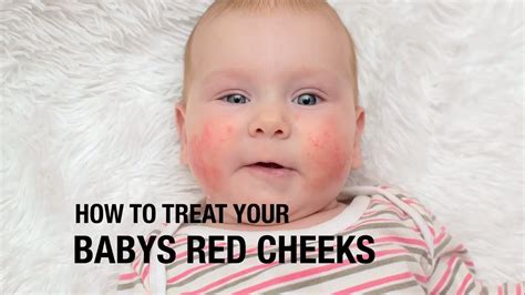 How To Treat Your Babys Red Cheeks Youtube