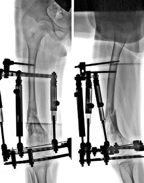 Ap And Lat Radiographs Of The Femur Demonstrating Proper Alignment And