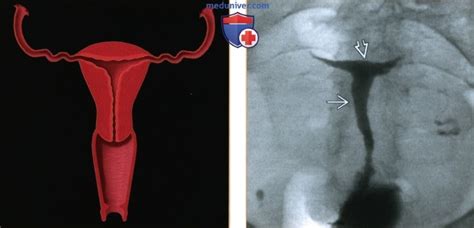 Лучевые признаки аномалии матки от диэтилстильбэстрола ДЭС