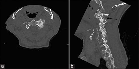 Occipital Neuralgia Secondary To Unilateral Atlantoaxial Osteoarthritis