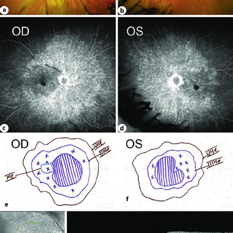 Fundus Photographs A B Late Fluorescein Angiogram C D And