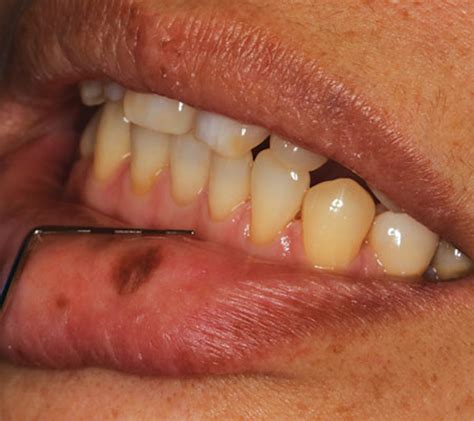 Oral Pathology Noting A Pigmented Macule That Often Presents A
