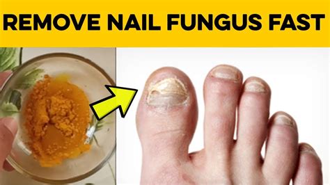 How To Cure Nail Fungus 2 Home Remedies For Toenail Fungus That Really Work Youtube