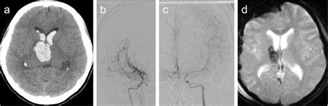 Initial Computed Tomography Describing Right Thalamic Hemorrhage With