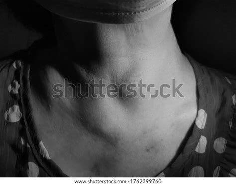 Anterior Neck Swelling Known Medically Goitre Foto Stock 1762399760