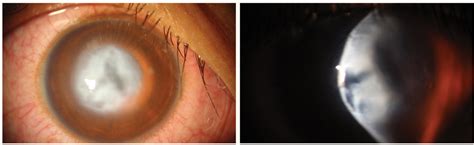 Lesson A New Consensus On Keratoconus