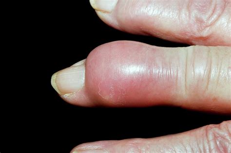 Gout Tophus On The Finger Photograph By Dr P Marazziscience Photo Library