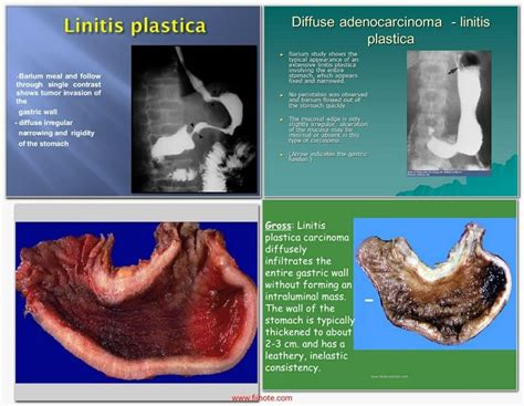 Linitis Plastica Leather Bottle Stomach Borman Stage 4 Gastric