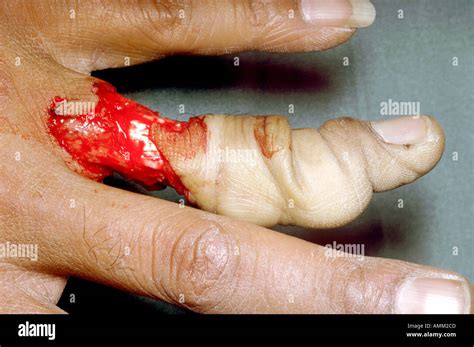 Degloving injury High Resolution Stock Photography and Images - Alamy