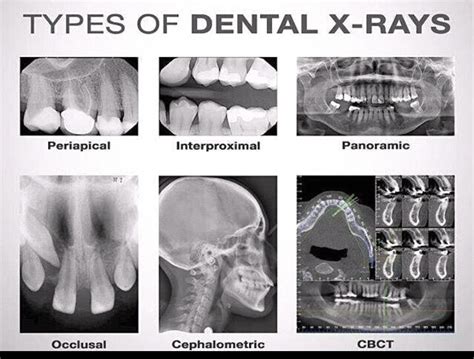 Types Of Dental X Rays Dental Dental Hygiene School Dental Hygenist