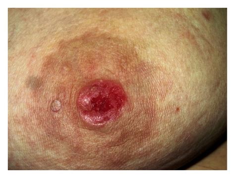 As paget's disease is a form of breast cancer, the sooner it's diagnosed, the better the outcome is likely to be. Figure 2 | Paget's Disease of the Breast in a Patient with ...
