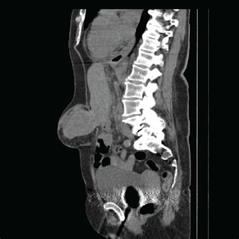 Sagittal Section Of Noninjected Ct Abdominal Scanner Demonstrating