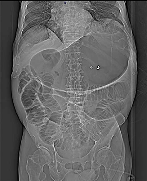 Plain Abdomen Radiography Shows Distended Stomach And Dilatated Loops