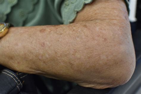 How To Get Rid Of Crepey Skin On Upper Arms