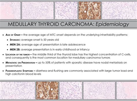 Medullary Thyroid Carcinoma Pathology Iowa Head And Neck Protocols