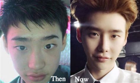 Lee Jong Suk Plastic Surgery Before And After Photos Latest Plastic