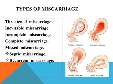 Miscarriages