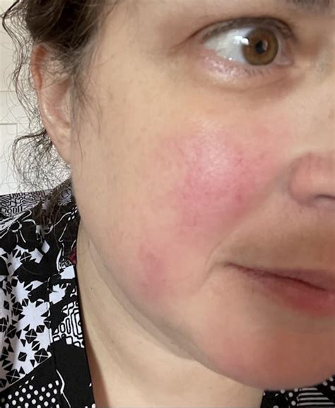 How Can You Tell A Lupus Rash From Rosacea I Get Lupus Uk