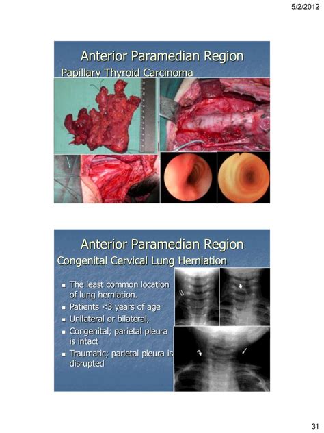 Clinico Radiological Approach For Diagnosis Of Neck Swellings