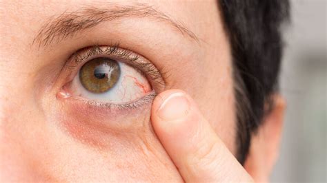 Een Gesprongen Adertje In Uw Oog Dan Is Er Meestal Niets Aan De Hand